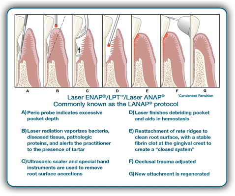 LANAP Laser Gum Therapy Manhattan | Laser Dentistry NYC