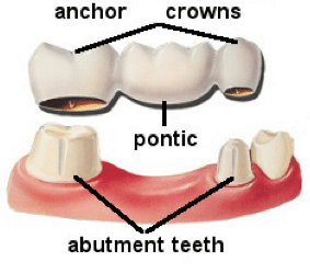 Dental Bridges NYC, Manhattan | Rockefeller Cosmetic Dentistry