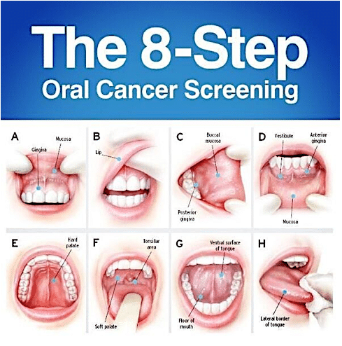 Oral Cancer Screening Test NYC - Rockefeller Cosmetic Dentistry